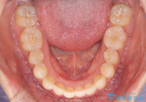 コンプレックスだった・・・唇が閉じなかった口元。綺麗になりました。の治療後