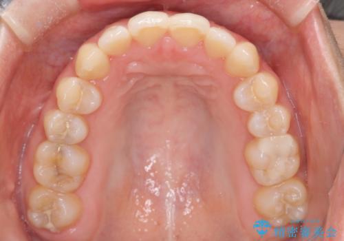 コンプレックスだった・・・唇が閉じなかった口元。綺麗になりました。の治療後