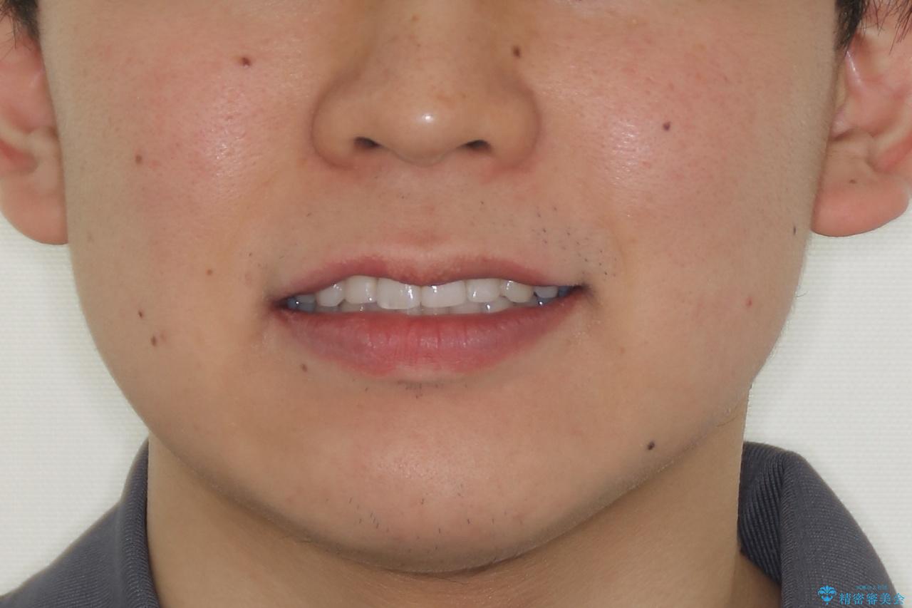 『目立たない装置で前歯のガタガタを治したい』インビザライン症例の治療後(顔貌)