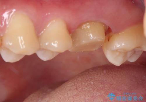 目立つ銀歯を白くしたい セラミック治療の治療中