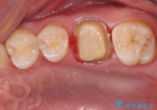 目立つ銀歯を白くしたい　セラミック治療の治療中