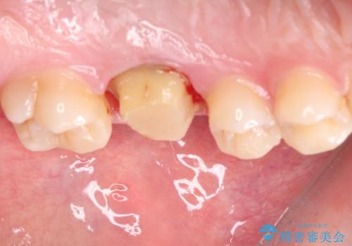 目立つ銀歯を白くしたい セラミック治療の治療中