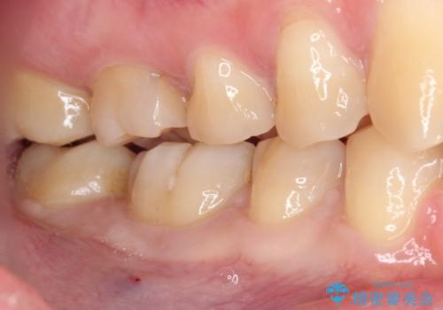 目立つ銀歯を白くしたい セラミック治療の治療中