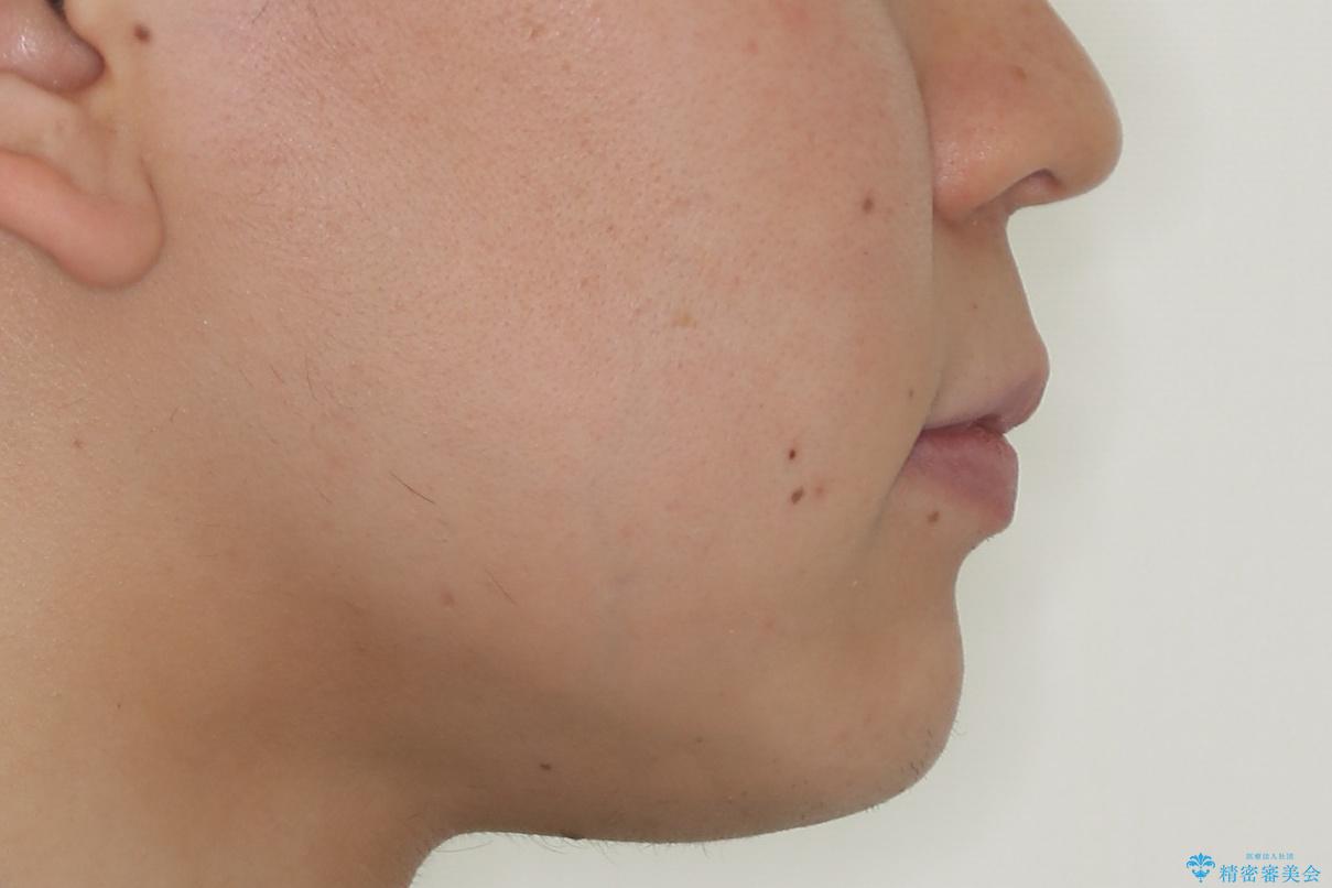 『目立たない装置で前歯のガタガタを治したい』インビザライン症例の治療後(顔貌)