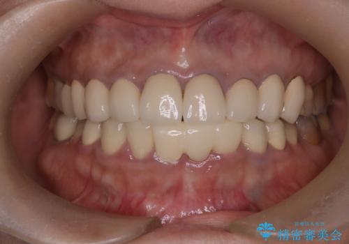 前歯が一本取れた オールセラミックブリッジによる補綴治療の治療前