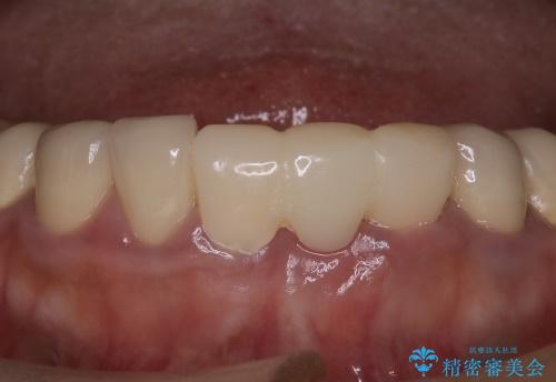 前歯が一本取れた　オールセラミックブリッジによる補綴治療の治療前