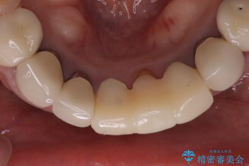 前歯が一本取れた オールセラミックブリッジによる補綴治療の治療前