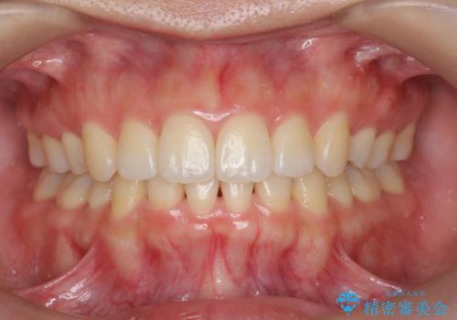 再矯正 昔ワイヤーで治療 前歯の並びを再度きれいにの症例 治療後