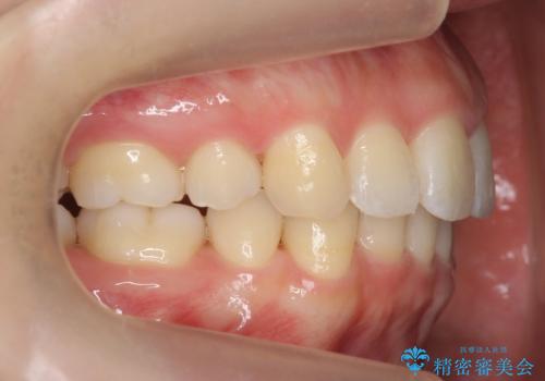 再矯正 昔ワイヤーで治療 前歯の並びを再度きれいにの治療後