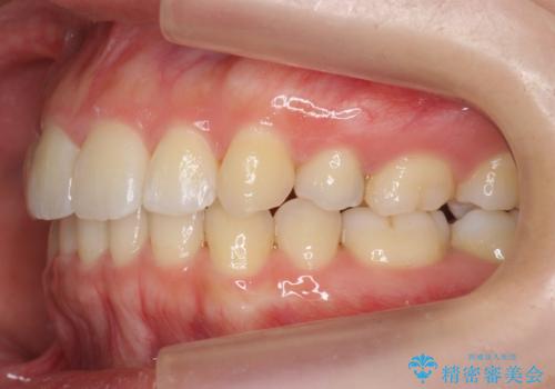 再矯正 昔ワイヤーで治療 前歯の並びを再度きれいにの治療後