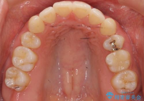 再矯正 昔ワイヤーで治療 前歯の並びを再度きれいにの治療後