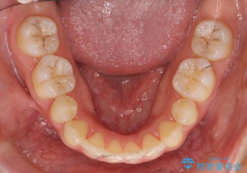 再矯正 昔ワイヤーで治療 前歯の並びを再度きれいにの治療後