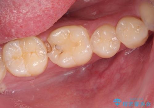 冷たいものがしみる 奥歯のセラミックインレーの症例 治療前