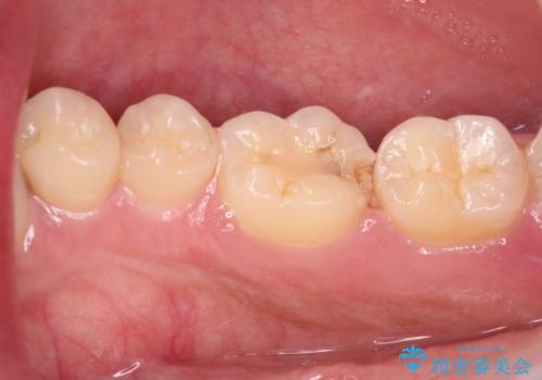 冷たいものがしみる 奥歯のセラミックインレーの治療前