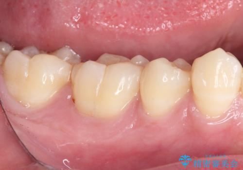 冷たいものがしみる 奥歯のセラミックインレーの治療前