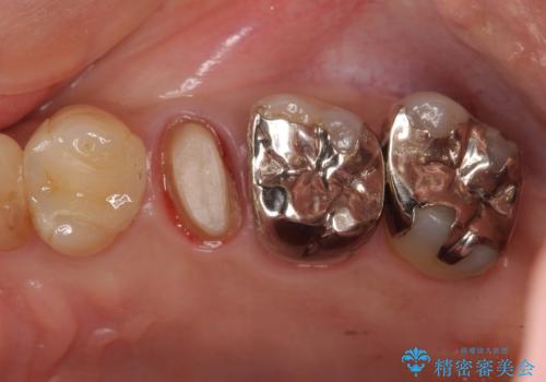 他院で抜歯と言われた 残したいの治療中