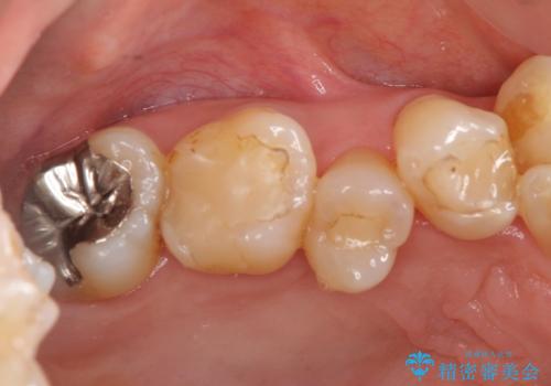 奥歯の銀歯、プラスチックのやりかえの治療前