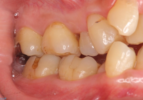 奥歯の銀歯、プラスチックのやりかえの治療前