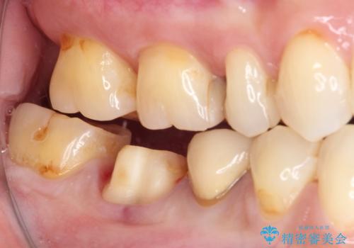 奥歯が欠けてしまった オールセラミッククラウンによる補綴治療の治療中