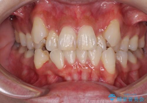 気になる八重歯を目立たない装置で改善　ハーフリンガル矯正の症例 治療前