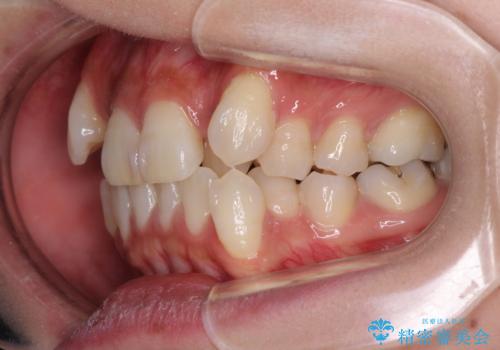 気になる八重歯を目立たない装置で改善　ハーフリンガル矯正の治療前