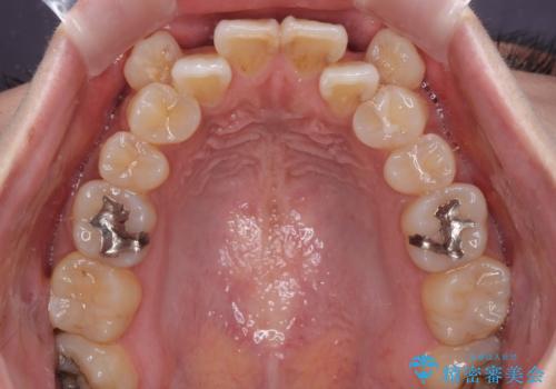 気になる八重歯を目立たない装置で改善　ハーフリンガル矯正の治療前