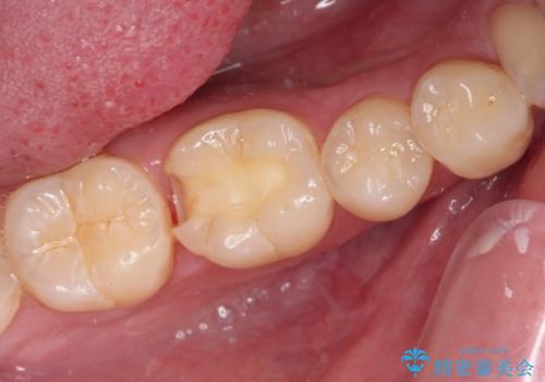 冷たいものがしみる 奥歯のセラミックインレーの治療中