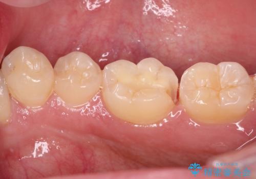 冷たいものがしみる 奥歯のセラミックインレーの治療中