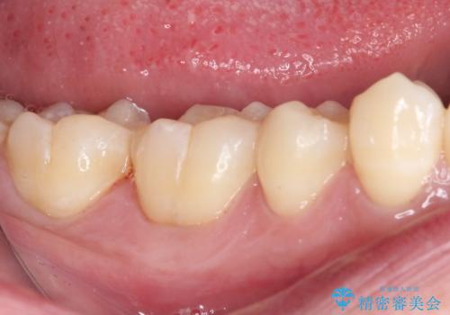 冷たいものがしみる 奥歯のセラミックインレーの治療中