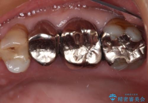 詰め物が欠けた　オールセラミッククラウンによる虫歯治療の症例 治療前