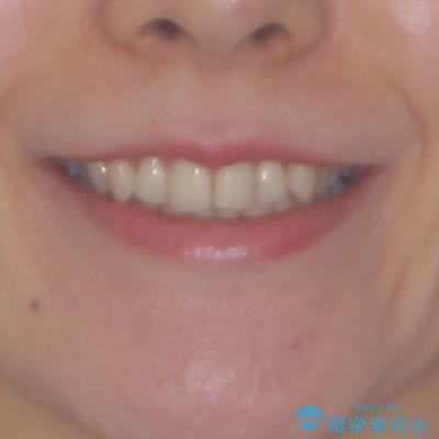 矯正治療の後戻り インビザライン・ライトによる矯正治療の治療前(顔貌)
