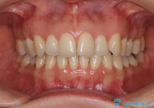 矯正治療の後戻り インビザライン・ライトによる矯正治療の症例 治療前