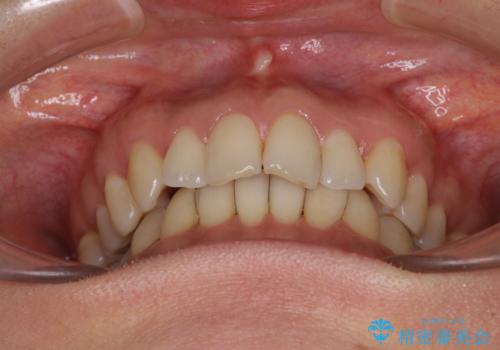 矯正治療の後戻り インビザライン・ライトによる矯正治療の治療前