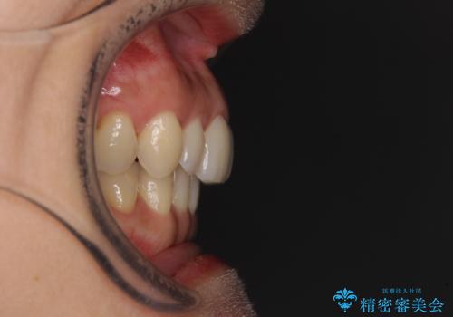 矯正治療の後戻り インビザライン・ライトによる矯正治療の治療前