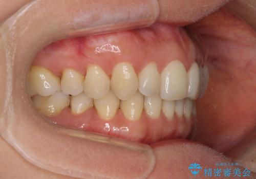 矯正治療の後戻り インビザライン・ライトによる矯正治療の治療前