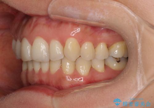 矯正治療の後戻り インビザライン・ライトによる矯正治療の治療前