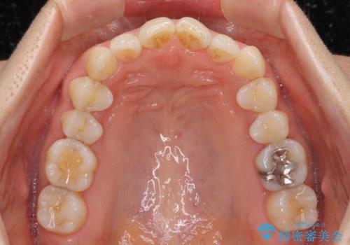 矯正治療の後戻り インビザライン・ライトによる矯正治療の治療前