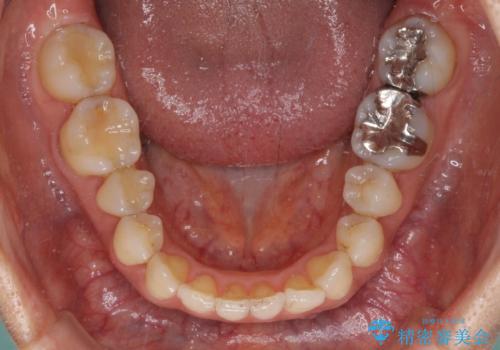矯正治療の後戻り インビザライン・ライトによる矯正治療の治療前