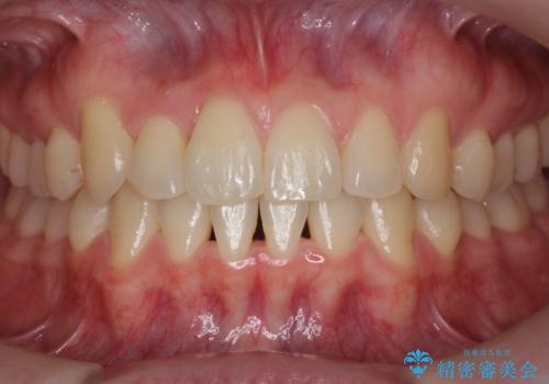 引っ込んだ前歯を並べる　歯を抜かないマウスピース矯正の症例 治療後