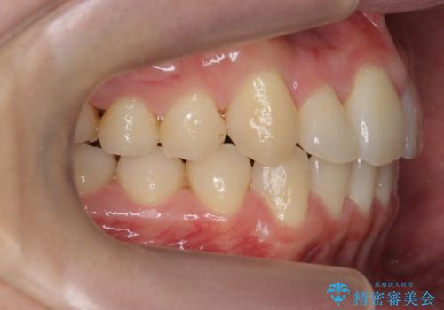 引っ込んだ前歯を並べる　歯を抜かないマウスピース矯正の治療後