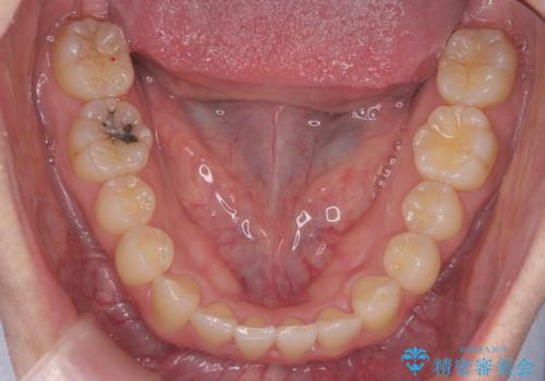 引っ込んだ前歯を並べる　歯を抜かないマウスピース矯正の治療後