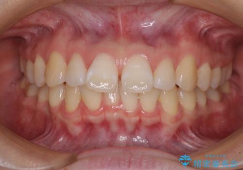 【モニター】すきっ歯をインビザラインで解消の症例 治療前