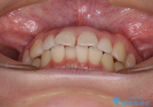 【モニター】すきっ歯をインビザラインで解消の治療前