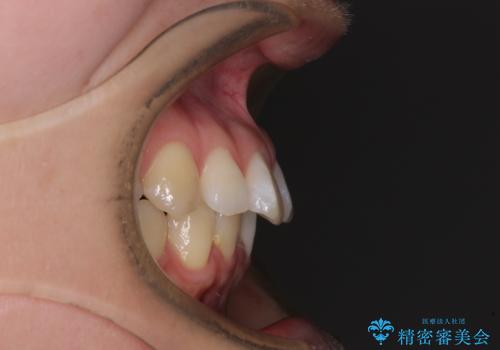 【モニター】すきっ歯をインビザラインで解消の治療前