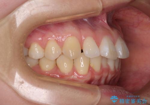 【モニター】すきっ歯をインビザラインで解消の治療前