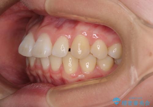 【モニター】すきっ歯をインビザラインで解消の治療前