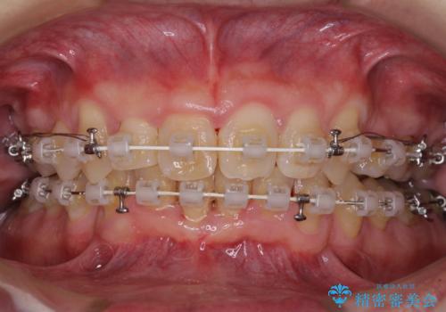 前歯が折れたついでに歯並びも改善 矯正治療と前歯のセラミック治療の治療中