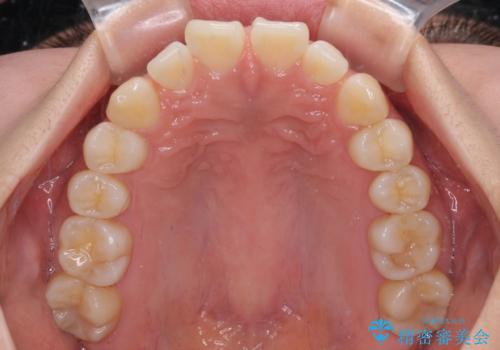 【モニター】すきっ歯をインビザラインで解消の治療前