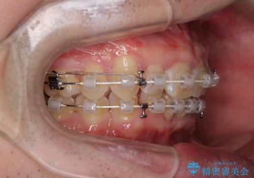 前歯が折れたついでに歯並びも改善 矯正治療と前歯のセラミック治療の治療中