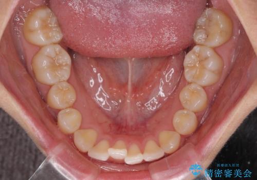【モニター】すきっ歯をインビザラインで解消の治療前